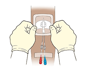 Closeup of arm with midline catheter. Gloved hands placing clean dressing over catheter and insertion site. Tape secures two lines to skin.