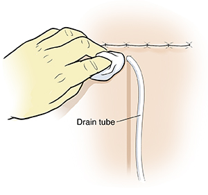 Closeup of gloved hand cleaning skin around drainage tube near surgical incision.