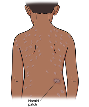 Outline of child from back showing rash on back. One large spot of rash is herald patch.